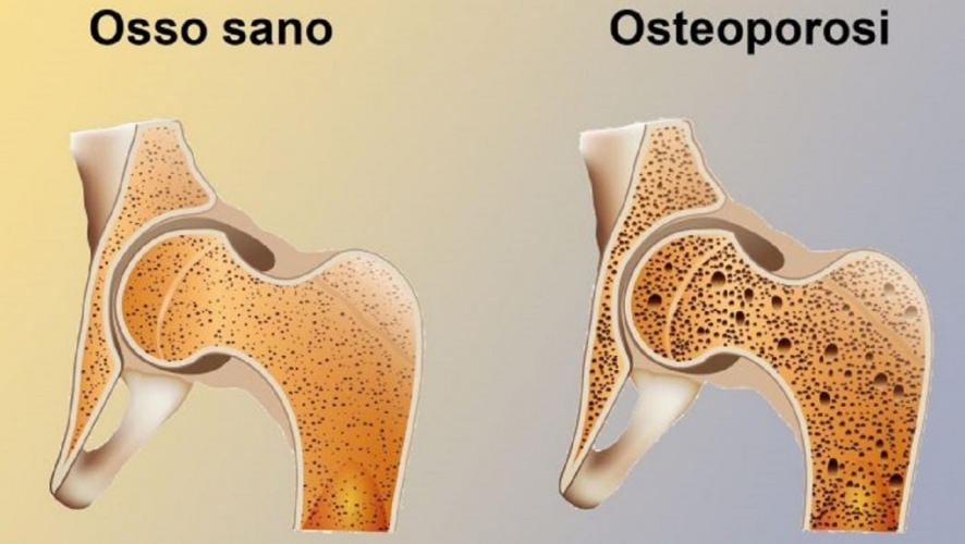 osteoporosi ossa fragili