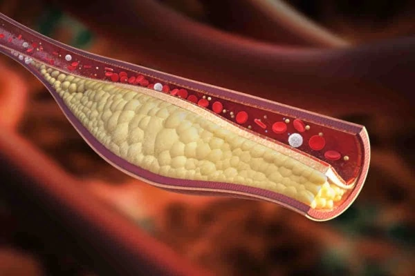 12 alimenti per pulire le arterie